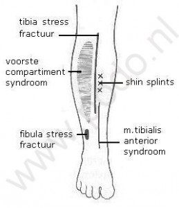 shinsplints1