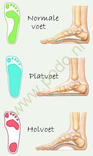 voettypen